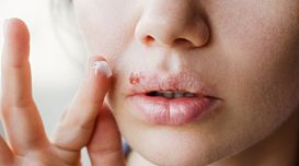 Here Are 5 Cold Sore Remedies To Tr...