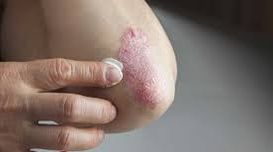 2023, Psoriasis Market | Industry A...