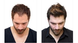 Before And After Hair Transplant – ...