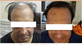Hair Transplant: Procedure and Reco...