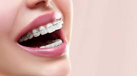 What Are the Benefits of Braces?   